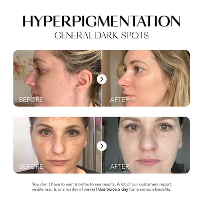 Dark Spot Corrector | 1+1 FREE