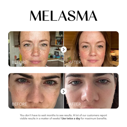 Dark Spot Corrector | 1+1 FREE