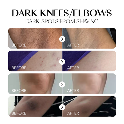 Dark Spot Corrector | 1+1 FREE