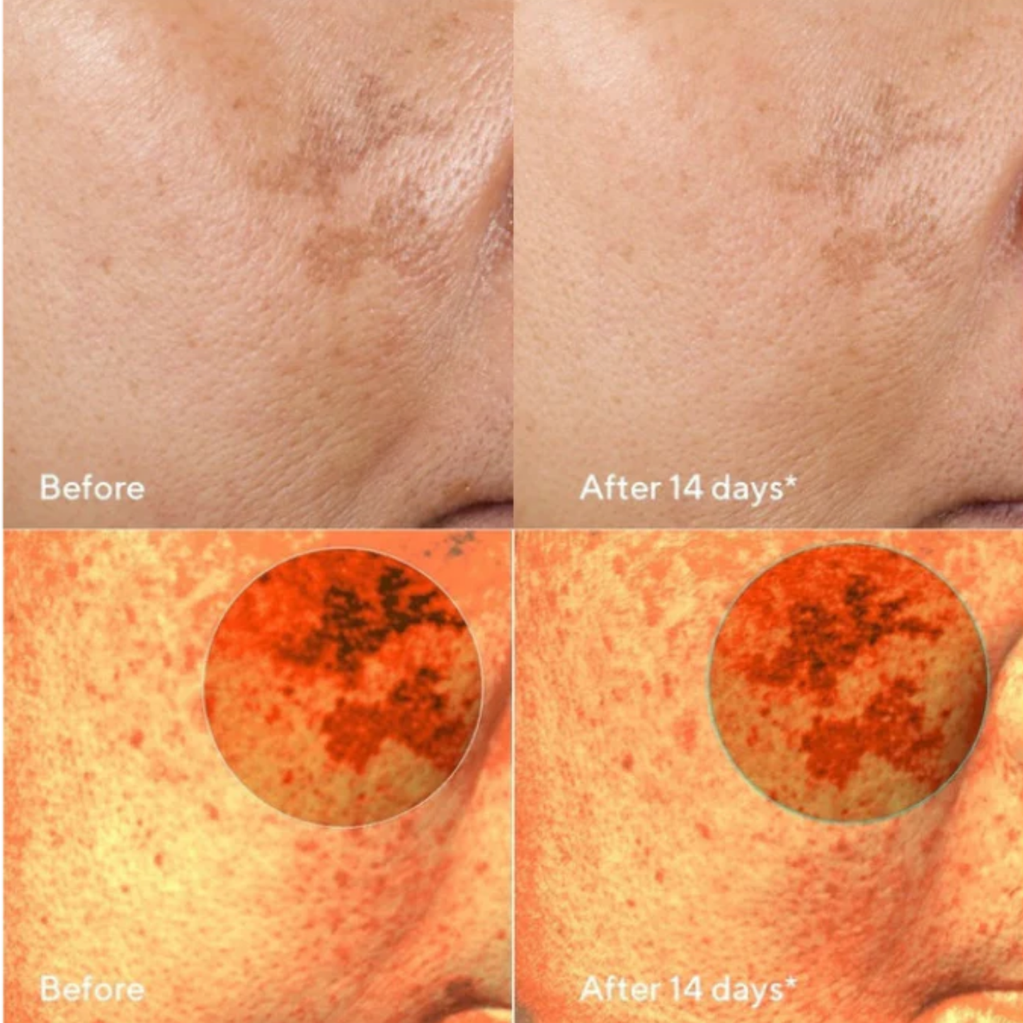 Clinical Hyperpigmentation Treatment Set