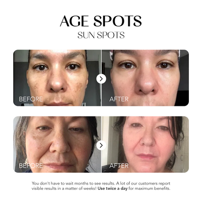 Dark Spot Corrector | 1+1 FREE